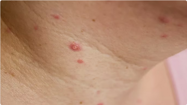 برلين تسجّل أول إصابة بجدري القرود "إمبوكس" من الفئة "1ب"